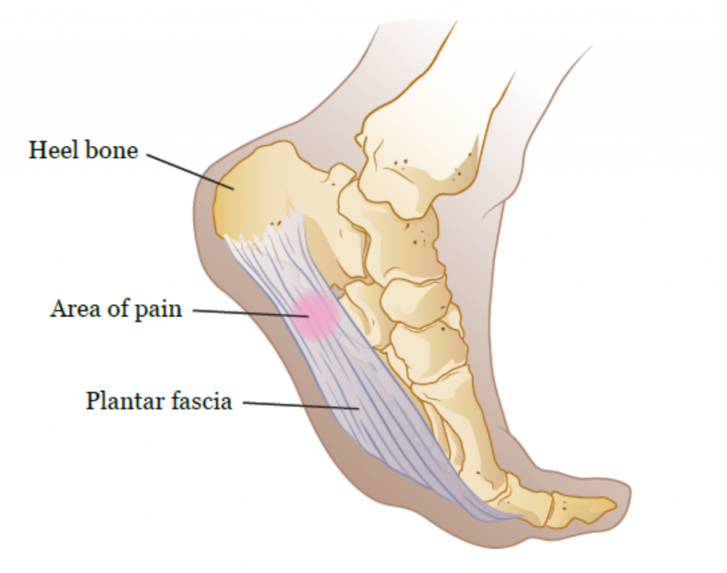 Rupture of the Plantar Fascia - Everything You Need To Know - Dr